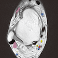 足関節MRI(横断像-右側)