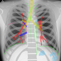 胸部X線(正面像)