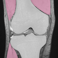 knee MRI(coronal)