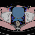 lower abdominal CT