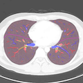 Chest CT(lung window)