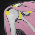 肩関節MRIの正常解剖(斜冠状断像)