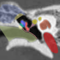側頭骨CT(冠状断像-右側)